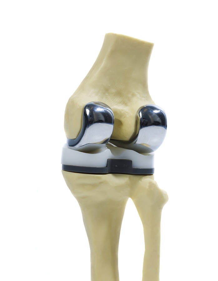 Total Knee Replacement Senior Care Central