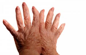 Arthritic Hands