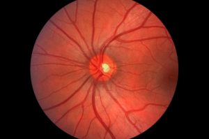 Glaucoma Symptoms